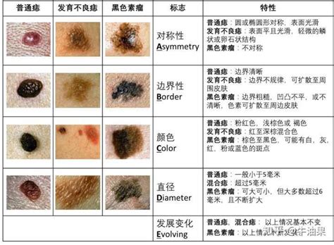 臉部黑痣|痣是什麼？會變成黑色素瘤？7種一定要除的痣